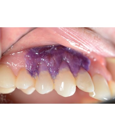 Kit Periacryl HV 5ml